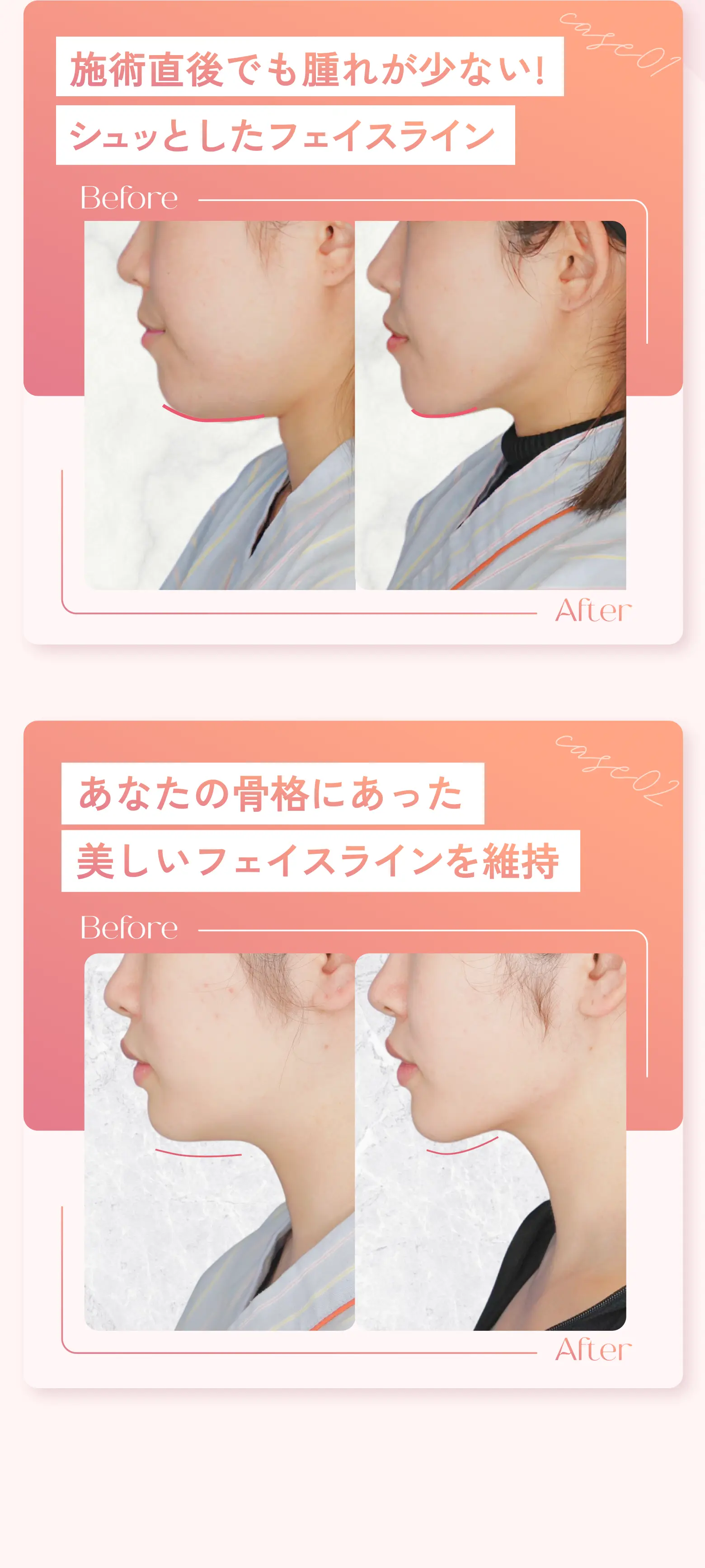 VBCのパーフェクトVラインなら施術直後でも腫れが少ないシュッとしたフェイスライン形成 あなたの骨格にあった美しいフェイスラインを維持
