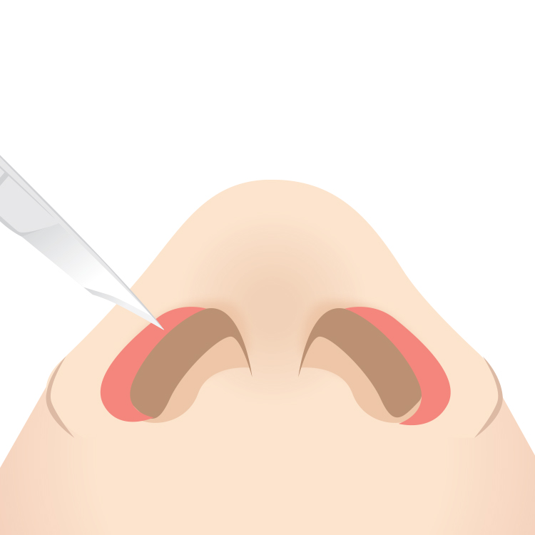 鼻孔縁挙上－麻酔・手術
