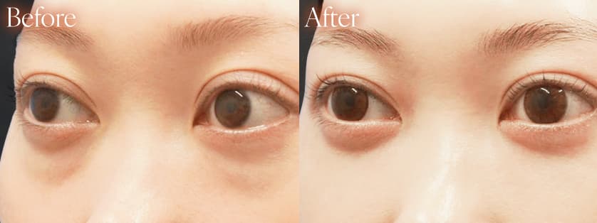 脂肪吸引/糸リフトbefore after