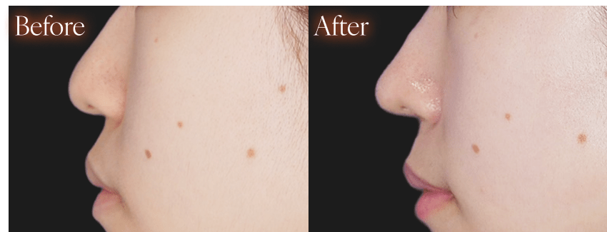 鼻施術before after