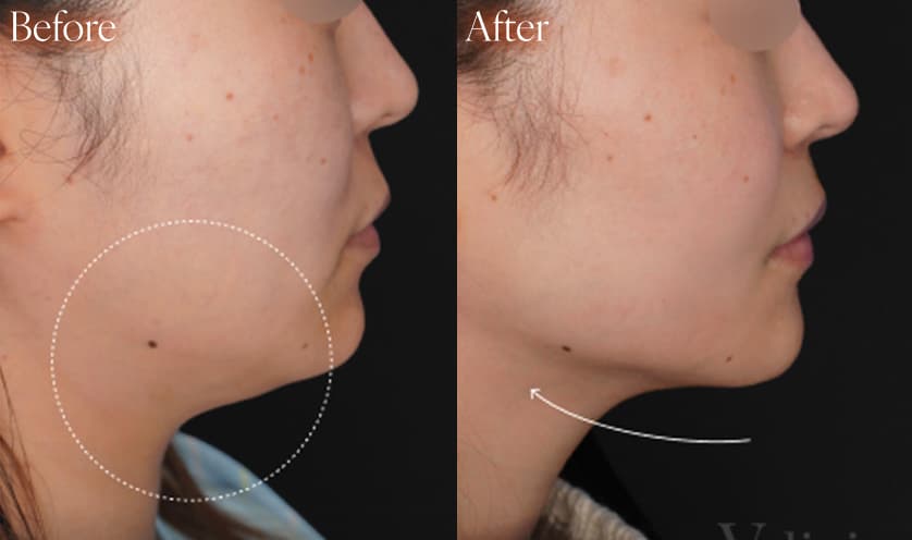 脂肪吸引/糸リフトbefore after