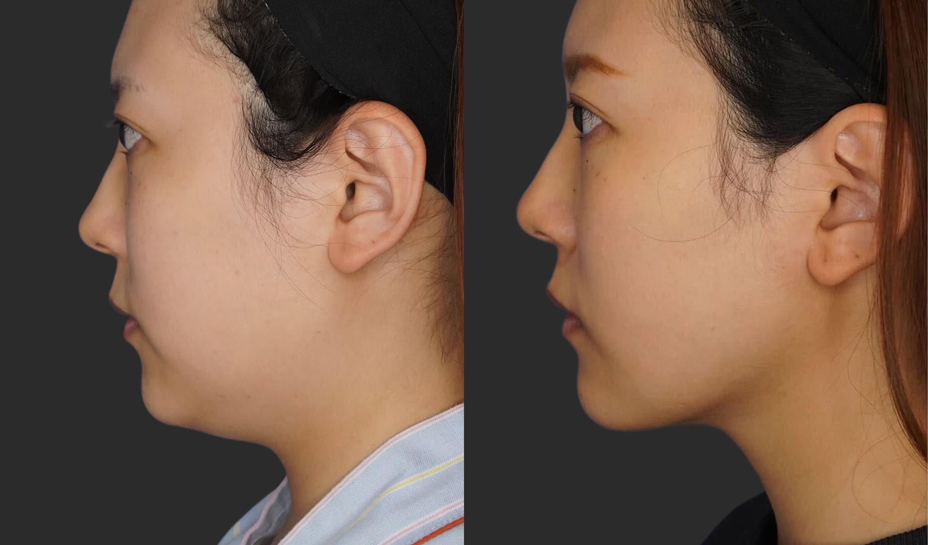 Before After