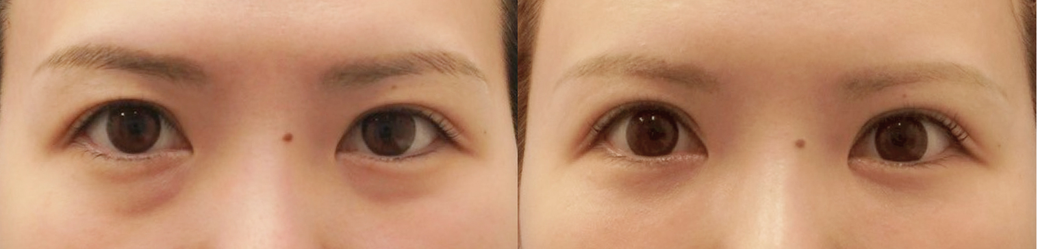 Before After