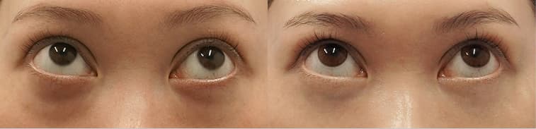 Before After