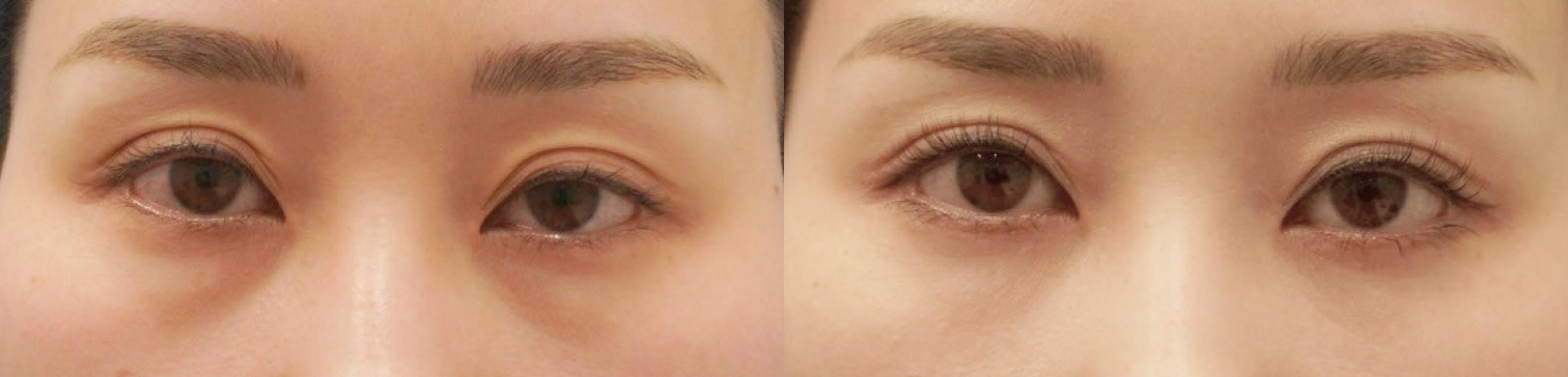 Before After