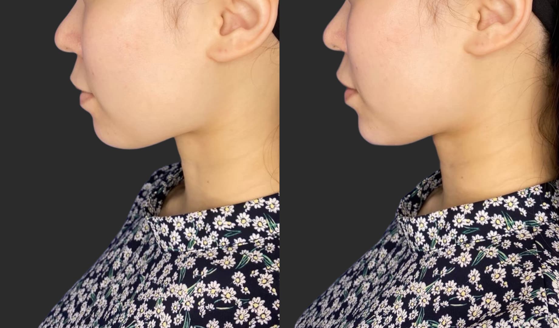 Before After