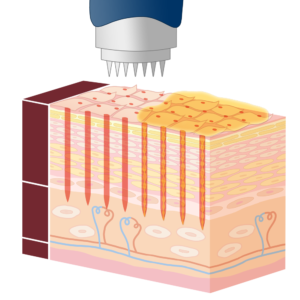ダーマペンの仕組み