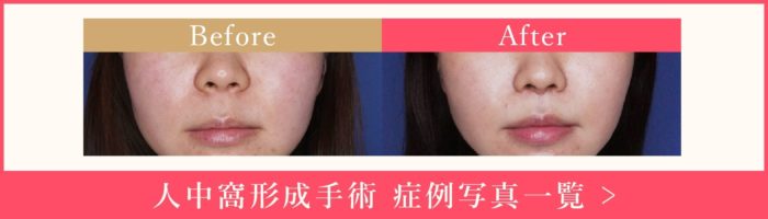 人中窩形成 美容外科 整形 Venus Beauty Clinic 東京都 新宿 銀座