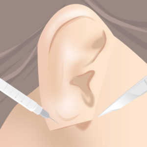 耳たぶ縮小術（麻酔・手術）