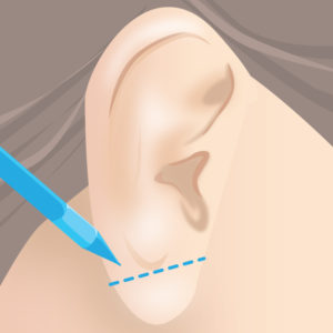 耳たぶ縮小術（マーキング）