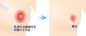 乳輪縮小 Venus Beauty Clinic 新宿 銀座