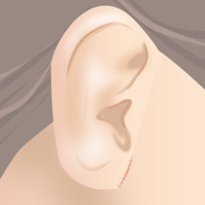 耳たぶ縮小術（縫合）