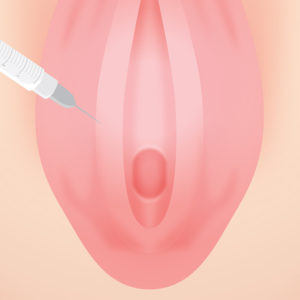 膣縮小手術