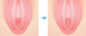 子宮口膣ヒダ 膣縮小手術はVENUS BEAUTY CLINIC（東京都新宿・銀座）
