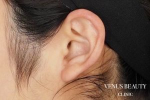 耳たぶ縮小術 施術後