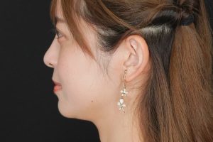 糸リフト 施術前