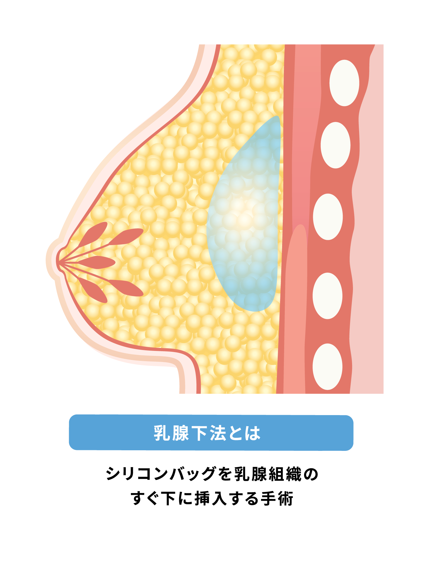 乳腺下法~リシコン豊胸