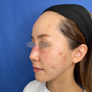 フォトフェイシャルM22（IPL） 施術前